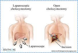 Laparoscopic and Open Cholecystectomy