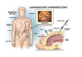 Advanced Laparoscopic Surgery