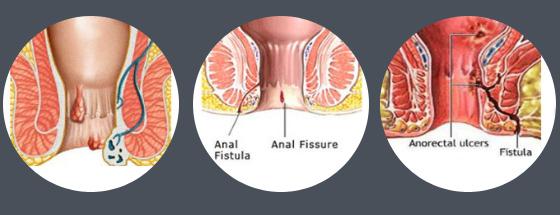 Piles, Fissures, and Fistulas