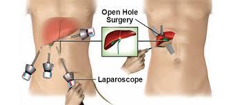 Hernia - Laparoscopic and open method