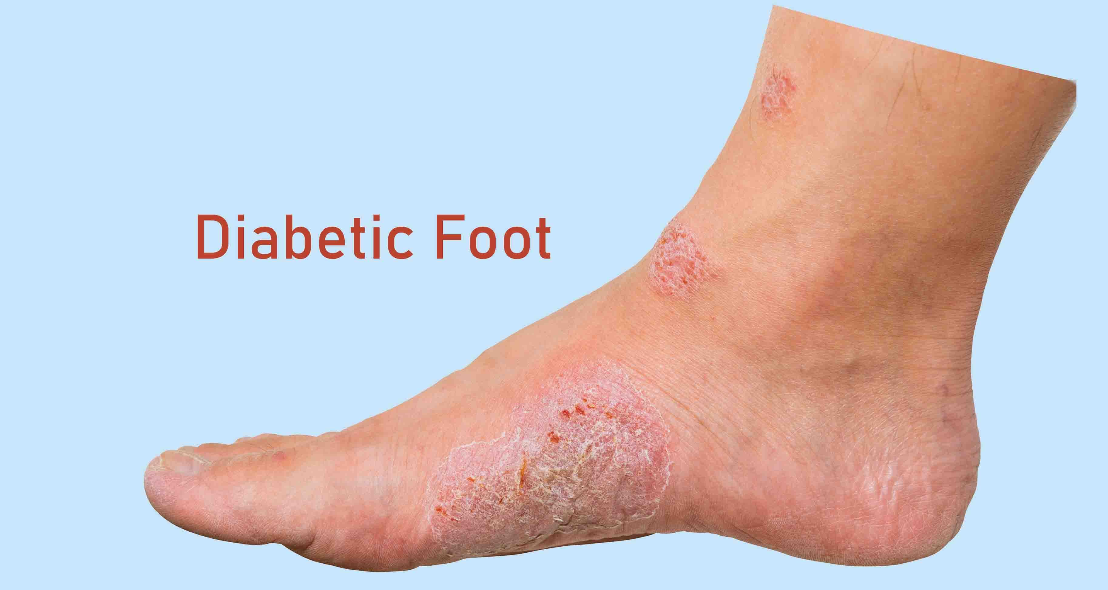 Diabetic Foot