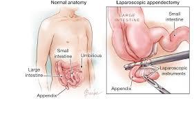 Laparoscopic vs. Open Appendicectomy