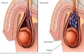 Hydrocele and Varicocele Surgery